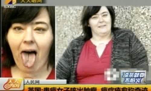 北京肿瘤医院癌症筛查 跨世纪奇迹：28年前癌症晚期！肿瘤医院院长妻子这样痊愈~