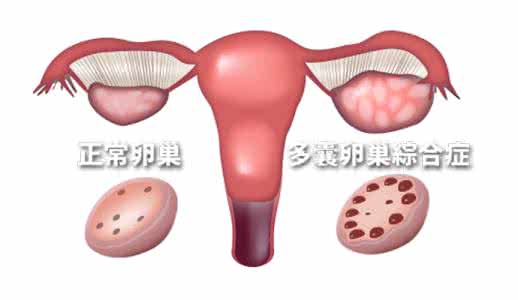 多囊卵巢综合症怀孕率 多囊卵巢综合症有哪些危害