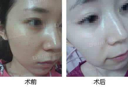 激光祛斑后恢复过程图 激光祛斑恢复 网友关注 激光祛斑后多久恢复