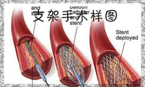 软化血管的食物 软化血管的食物 5种食物帮你的血管“洗洗澡”