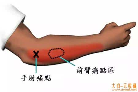 网球肘 曹老大拍打趣谈(5)—网球肘与便秘的关系