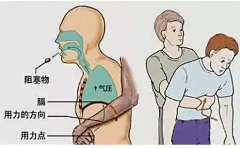 喉咙有异物感 关键时候能救命！孩子异物卡喉第一时间爸妈一定要这样做