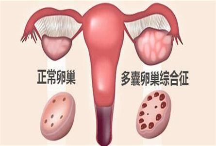 多囊卵巢促排卵怀孕 多囊卵巢不排卵怎么办 促排卵后，孕妈们应该怎样保养受过刺激的卵巢？