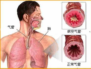 支气管哮喘和哮喘区别 支气管哮喘