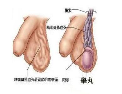 睾丸精索静脉曲张病因 睾丸静脉曲张 睾丸静脉曲张的病因