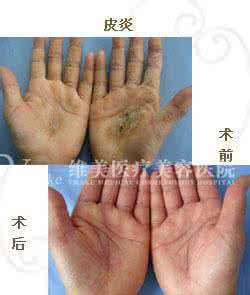 皮肤过敏能不能吃芒果 皮肤过敏能吃螃蟹吗 吃螃蟹过敏怎么办 皮肤过敏能不能吃螃蟹