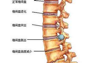 治腰椎病最新妙方 图文:9天治愈椎突病的妙方