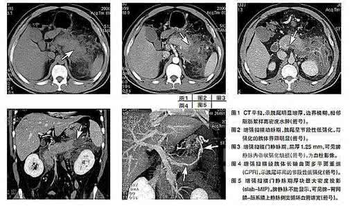 急性胰腺炎的病因 坏死性胰腺炎病因 如何治疗坏死性胰腺炎