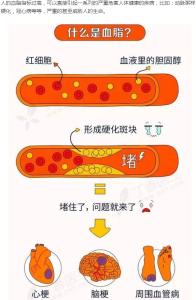 高血脂怎么调理 高血脂怎么调理 高血脂自我调理方法