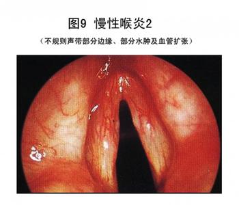 咽喉炎最佳治疗方法 “乌”医说道——咽炎喉炎、扁桃腺后遗症、多痰简单疗法