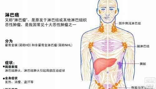 淋巴肿瘤有什么症状 淋巴肿瘤 淋巴肿瘤有哪些症状