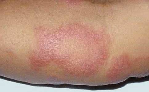 结核样型麻风 界线类偏结核样型麻风