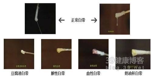 白带异常有哪些 白带异常有哪些 白带的类型有哪些
