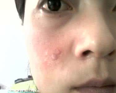 亲密接触痤疮会传染吗 痤疮传染么