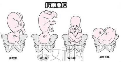 胎位不正纠正图 胎位不正怎么纠正 胎位不正如何纠正的方法 正常分娩有助胎儿健康