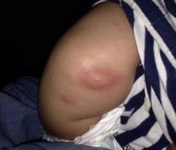 蚊子叮咬后红肿不消 被蚊子叮咬后红肿硬 喝上一两杯啤酒 被蚊子叮咬几率增15%