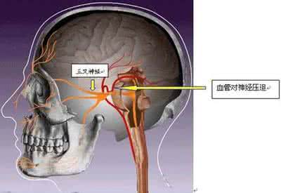 神经痛的症状 神经痛的症状 不同神经痛对症治疗