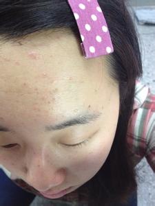 额头上长小米粒疙瘩 额头上长疙瘩的治疗食谱