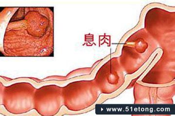 直肠息肉癌变几率 结直肠“大”息肉癌变率并不高