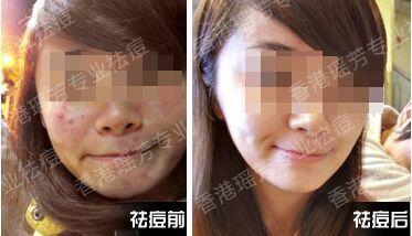 丘疹性痤疮怎么治疗 丘疹性痤疮怎么医治 什么方法