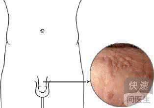 生殖器疱疹的传播途径 生殖器疱疹的传播途径 生殖器疱疹传播途径