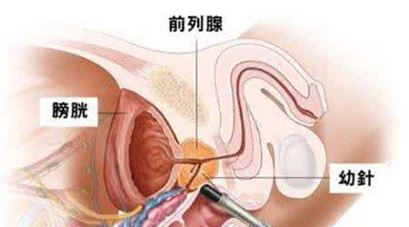 慢性前列腺炎治疗原则 性爱健康 慢性前列腺炎的症状及治疗原则_性爱健康