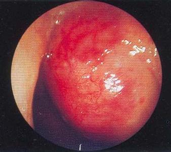 鼻咽癌3大体征7大症状 鼻咽癌的症状