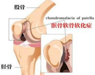 髌骨软化症 髌骨软化症 关于髌骨，你想知道的都在这！