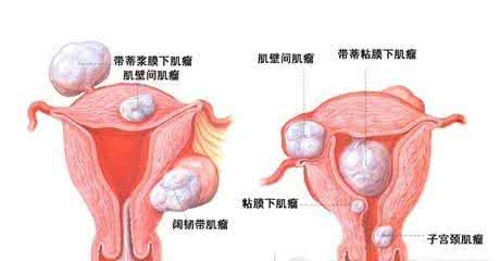 宫颈癌早期症状 宫颈癌早期症状 宫颈癌的症状与治疗方法