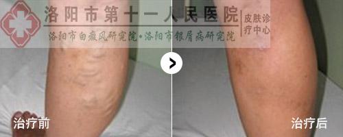 银屑病能治愈吗 银屑病能治愈吗 如何治疗银屑病