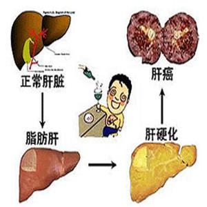 脂肪肝性肝炎 脂肪肝和脂肪性肝炎有什么区别