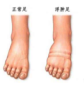 女性下肢水肿的原因 下肢水肿