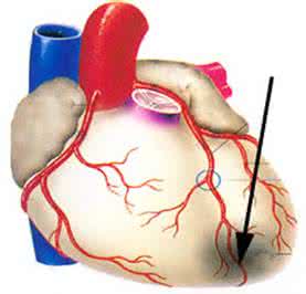 肥厚心肌病治疗方法 肥厚性心肌病 它的治疗方法有哪些
