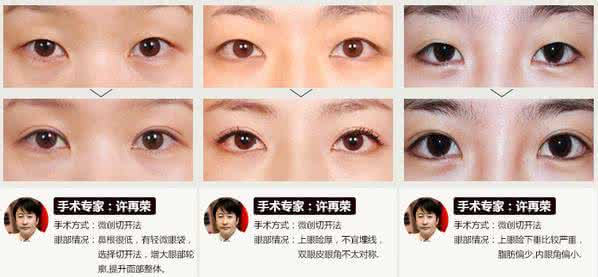 上海眼部整形医院 上海眼部整形医院 眼部整形必须关注的六个问题