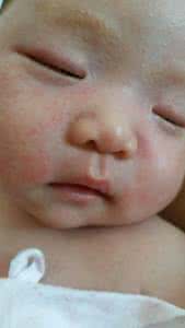 雅漾婴儿润肤霜 湿疹 耳朵湿疹怎么办 婴儿为什么耳朵里长湿疹 鹊肤专家回答