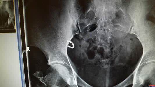 宫内节育器放置术 宫内节育器放置术 为什么放置节育器后仍会妊娠