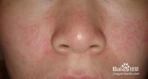 脂溢性皮炎该怎么治疗 脂溢性皮炎怎么治疗 有效治疗溢脂性皮炎