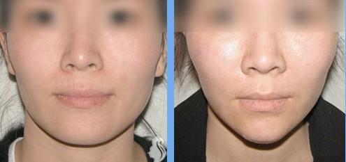 治疗下颌角肥胖 治疗下颌角肥胖 治疗下颌角肥胖 千万不能忽视身体的脂肪