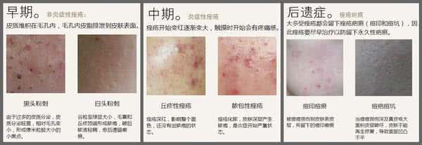 治疗痤疮最好的办法 痤疮的形成和治疗是什么