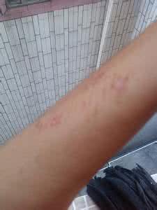 艾滋病发热是什么样 身体发热是艾滋病吗?