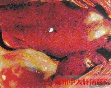 急性肝炎有什么症状 急性肝炎症状 急性肝炎有哪些表现