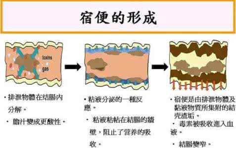 大肠水疗排出宿便图片 宿便是在大肠还是小肠？