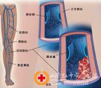 下肢静脉血栓形成原因 下肢深好脉血栓形成