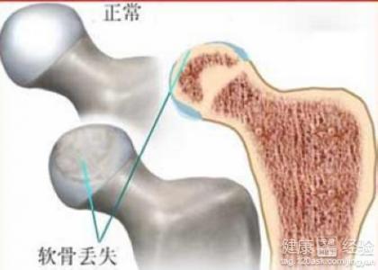 治疗股骨头坏死新方法 治股骨头坏死 这些方法有效治疗股骨头坏死