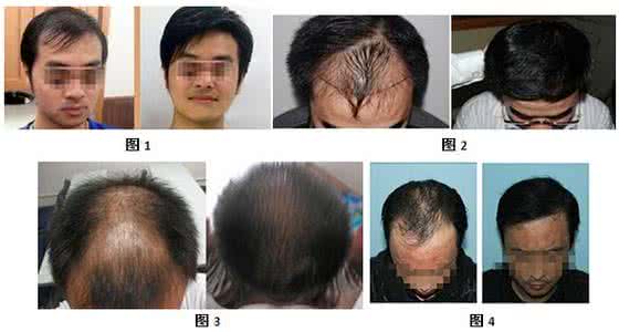 中医治疗掉头发 掉头发找中医吗 头发弄坏要找店赔钱吗？