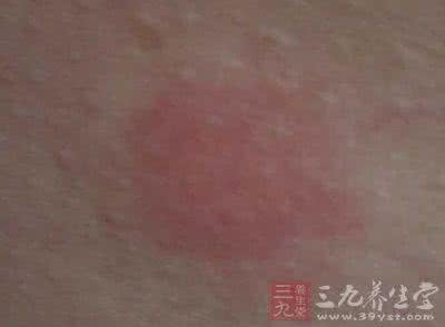 皮肤黑色素脱落 男人皮肤不断脱落全是被这病害的