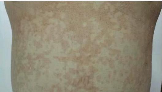 汗斑的最佳治疗方法 汗斑最佳的治疗方法是什么