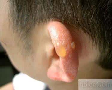 接触性皮炎症状 接触性皮炎症状 了解接触性皮炎的症状 及时做好防治工作