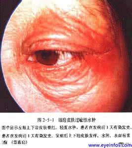 下眼睑水肿的原因 眼睑水肿怎么办 眼睑水肿可能是肾脏出现了病变，还不快点重视起来