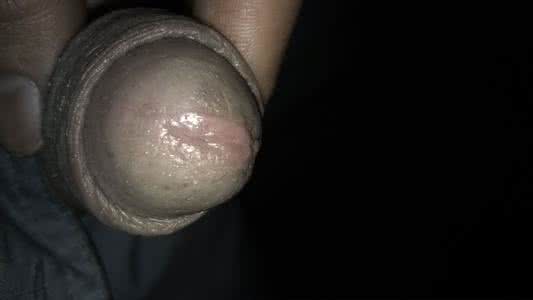 支原体衣原体感染症状 支原体衣原体感染症状 这些症状就要小心了